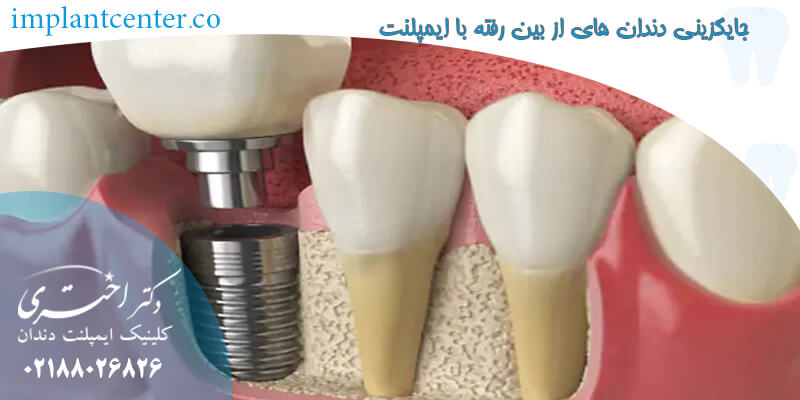 جایگزینی دندان های از بین رفته با ایمپلنت