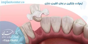 ایمپلنت جایگزین در زمان کشیدن دندان