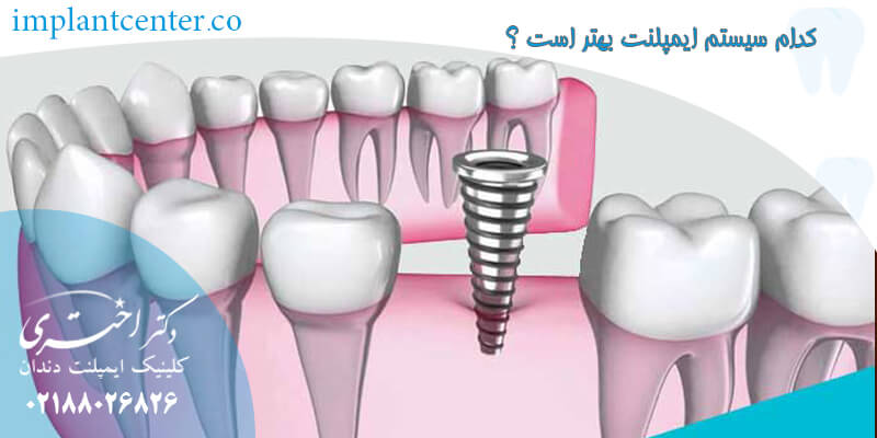 کدام سیستم ایمپلنت بهتر است ؟