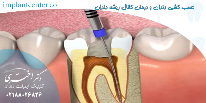 عصب کشی دندان و درمان کانال ریشه دندان