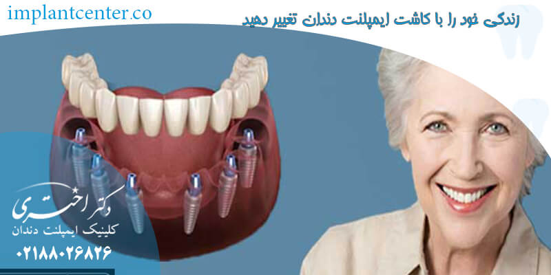 زندگی خود را با کاشت ایمپلنت دندان تغییر دهید