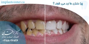 چرا دندان ها زرد می شوند ؟
