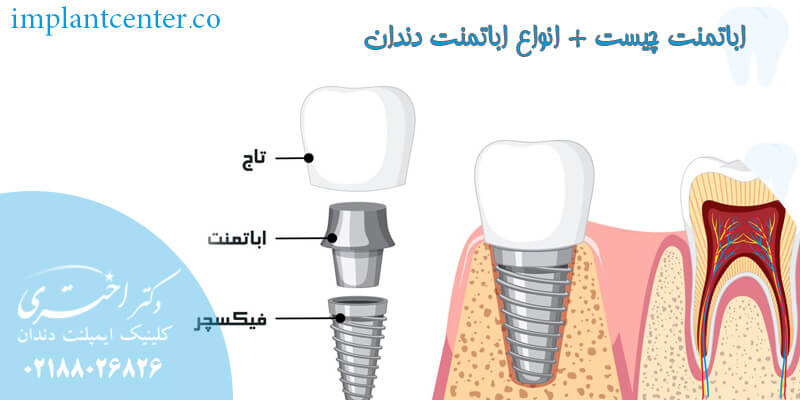 اباتمنت چیست
