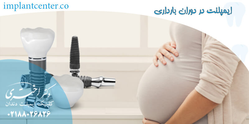 ایمپلنت-در-دوران-بارداری