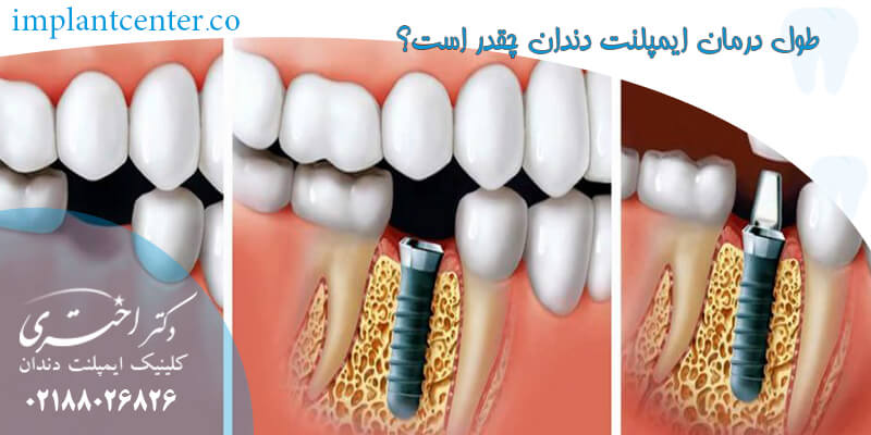 طول درمان ایمپلنت دندان چقدر است