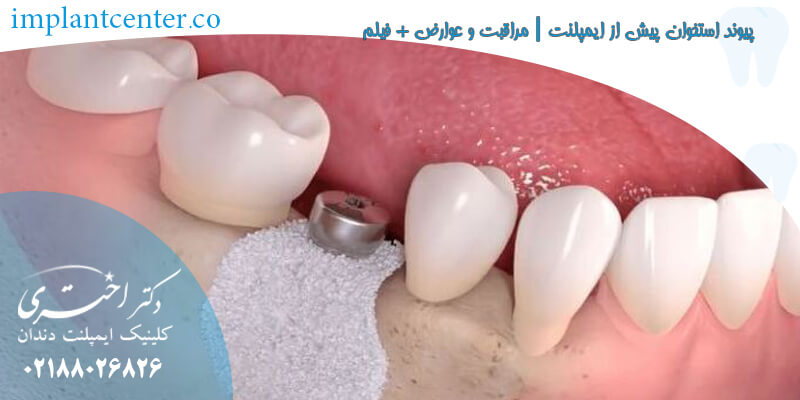 پیوند استخوان پیش از ایمپلنت | مراقبت و عوارض + فیلم