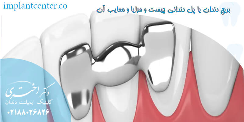 بریج دندان یا پل دندانی چیست و مزایا و معایب آن