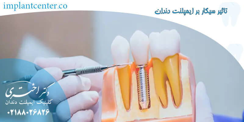 تاثیر سیگار بر ایمپلنت دندان