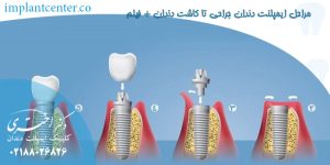 مراحل ایمپلنت دندان جراحی تا کاشت دندان + فیلم