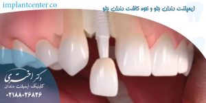 ایمپلنت دندان جلو و نحوه کاشت دندان جلو