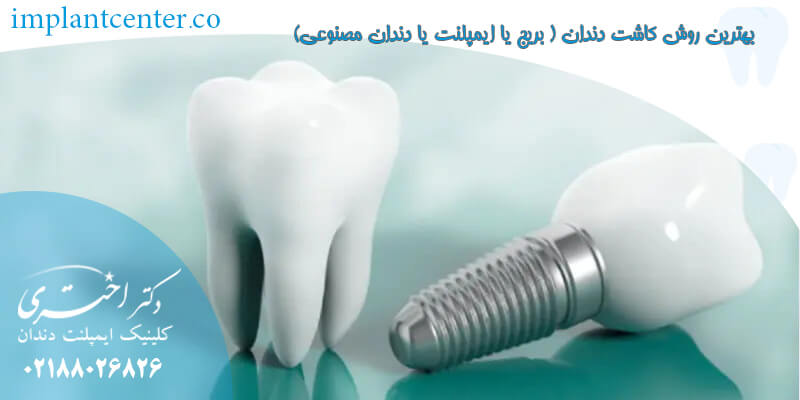 بهترین روش کاشت دندان ( بریج یا ایمپلنت یا دندان مصنوعی)