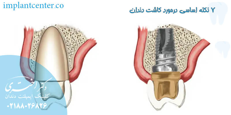 ۷-نکته-اساسی-درمورد-کاشت-دندان