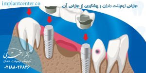 عوارض ایمپلنت دندان و پیشگیری از عوارض آن