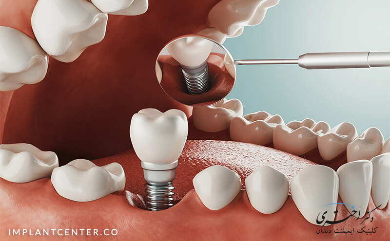 ایمپلنت دندان آسیاب بزرگ و ایمپلنت دندان آسیاب پایین بهترین روش جایگزین دندان از دست رفته است.