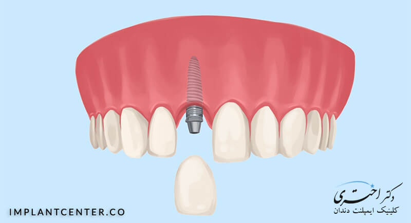 طریقه کاشت ایمپلنت دندان جلو در مطب دکتر فرشید اختری متخصص ایمپلنت چگونه انجام می شود؟