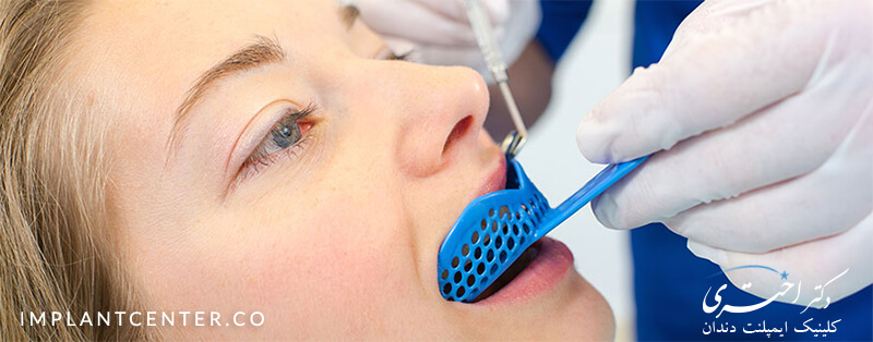 روش های قالب گیری ایمپلنت دندان چیست؟