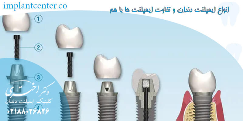 انواع ایمپلنت دندان و تفاوت ایمپلنت ها با هم