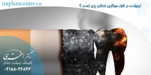 ایمپلنت در افراد سیگاری امکان پذیر است ؟