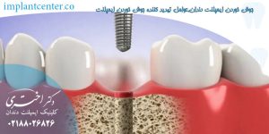 جوش خوردن ایمپلنت دندان,عوامل تهدید کننده جوش خوردن ایمپلنت