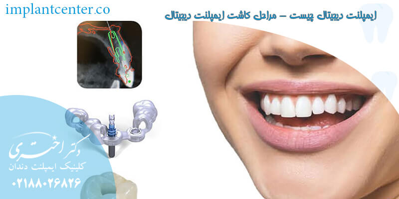 ایمپلنت دیجیتال چیست - مراحل کاشت ایمپلنت دیجیتال