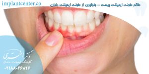 علائم عفونت ایمپلنت چیست - جلوگیری از عفونت ایمپلنت دندان
