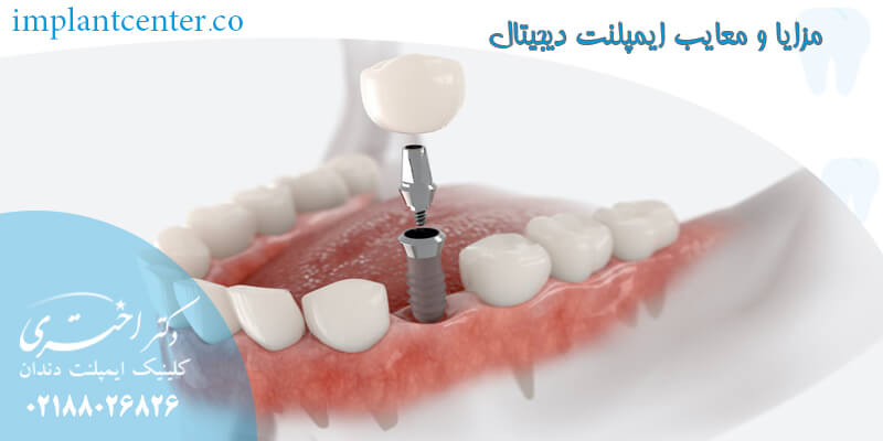 مزایا و معایب ایمپلنت دیجیتال