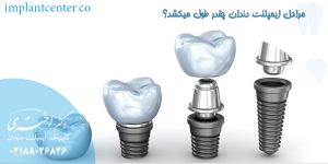 مراحل ایمپلنت دندان چقدر طول میکشد
