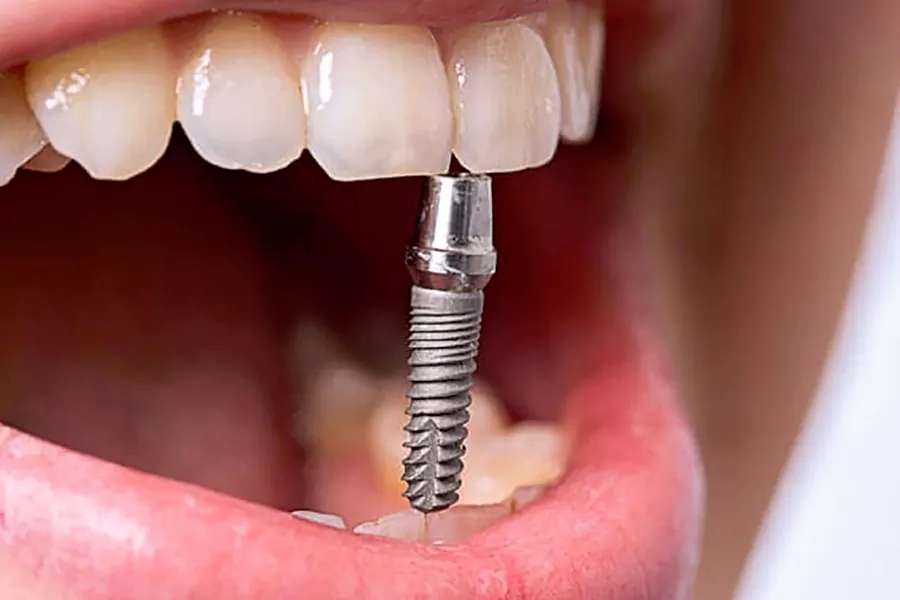 کاربرد انواع ایمپلنت‌ 