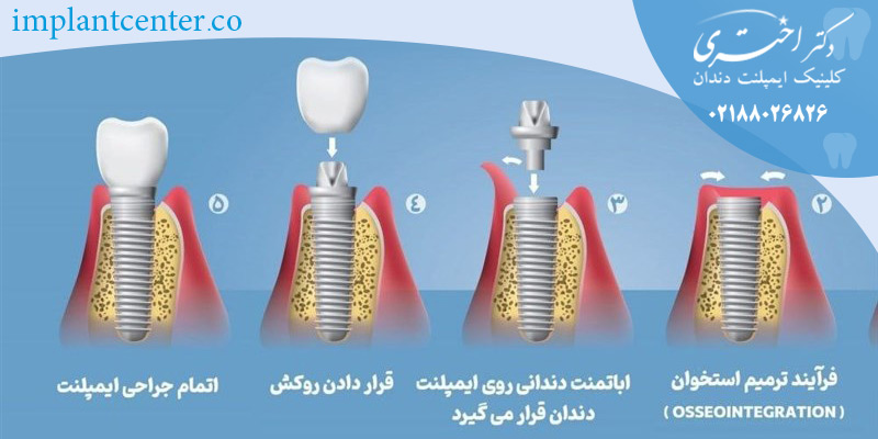 مقایسه ایمپلنت ثابت و متحرک 4 Dental Implant lifetime12