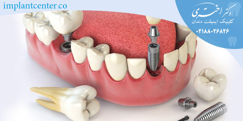 Dental Implant lifetime14