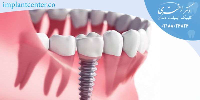 مقایسه ایمپلنت ثابت و متحرک 1 Dental Implant lifetime16