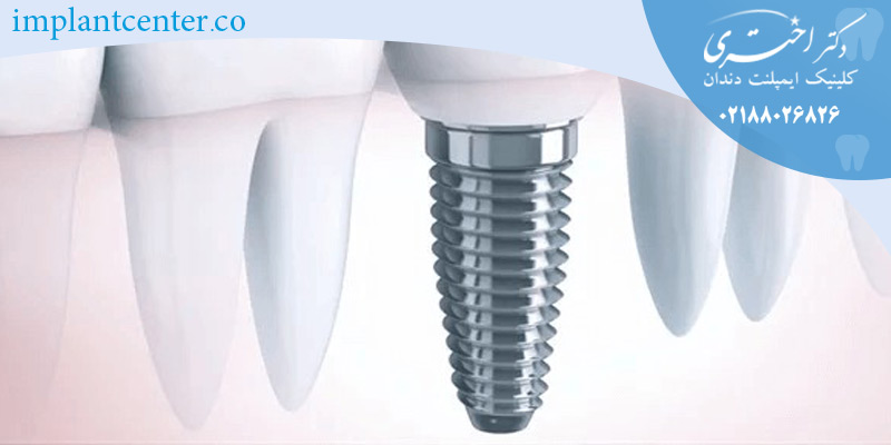 مقایسه ایمپلنت ثابت و متحرک 2 Dental Implant lifetime2 1