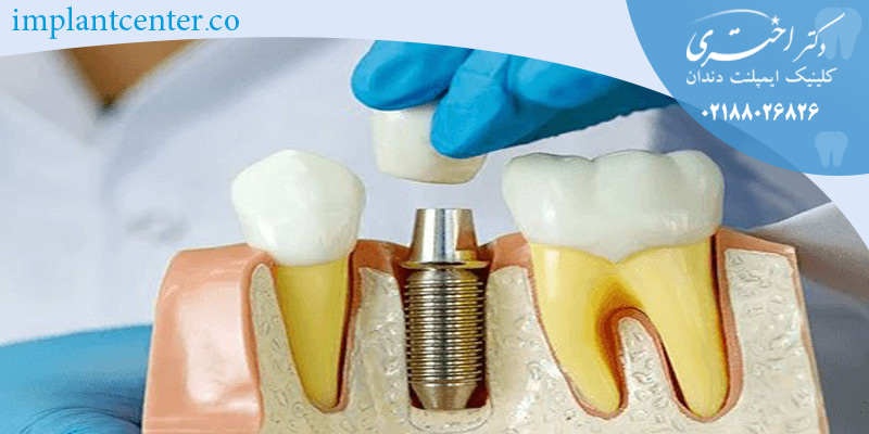 مقایسه ایمپلنت ثابت و متحرک 3 dental implants2