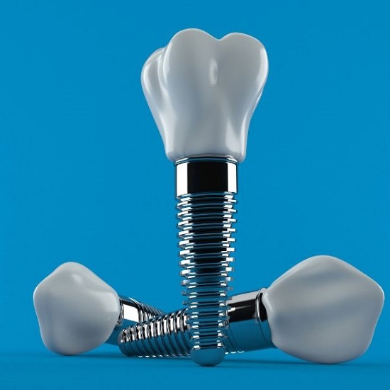 تفاوت ایمپلنت دندان ثابت و متحرک