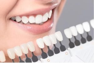 ایا میشود رنگ کامپوزیت را تغییر داد