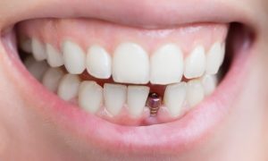 ایمپلنت دندان خرگوشی