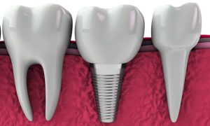 ایمپلنت دندان عقل