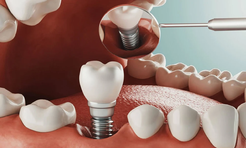 مشکلات رایج روکش ایمپلنت