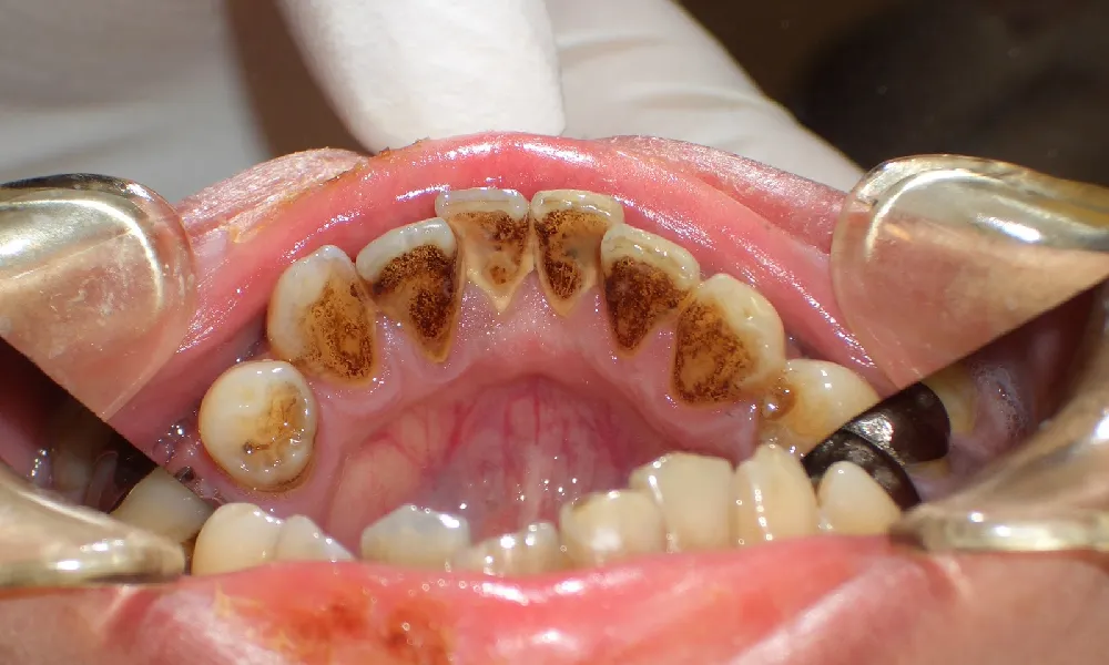 درمان‌های سیاه شدن دندان‌ها