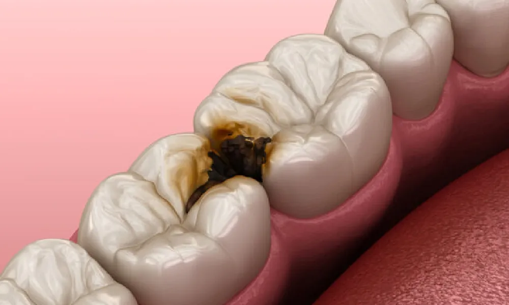 تغییرات سبک زندگی برای جلوگیری از سیاه شدن دندان‌ها