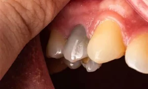 علت سیاه شدن دندان از داخل