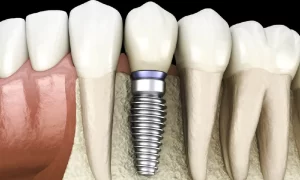 عوارض پودر استخوان در ایمپلنت