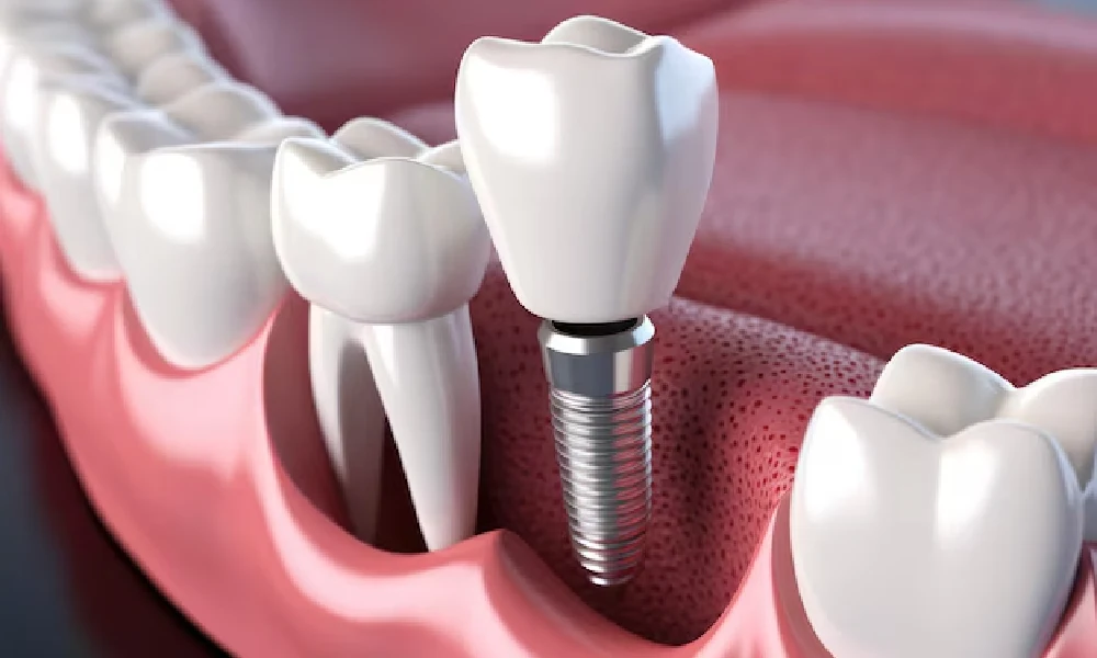 مشکلات روکش ایمپلنت