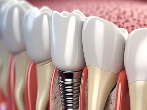 ایمپلنت دندان بیماران آرتریت روماتوئید