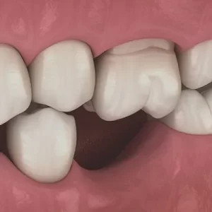 ایمپلنت برای جای خالی یک دندان