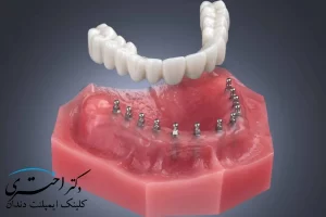 ایمپلنت دندان در یوسف آباد تهران