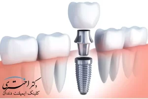 ایمپلنت در فاطمی تهران