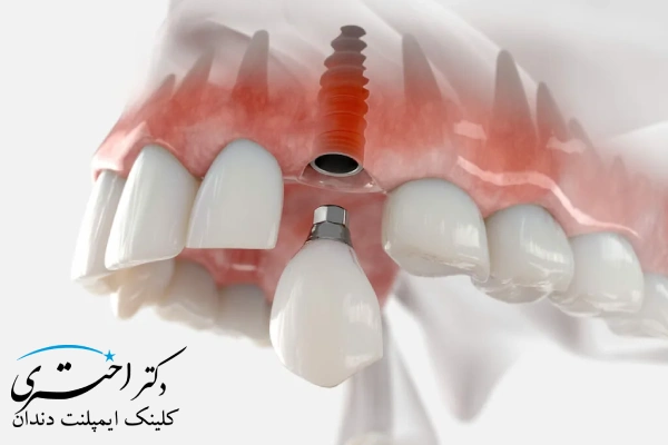 هزینه ایمپلنت در سعادت‌آباد چقدر است؟