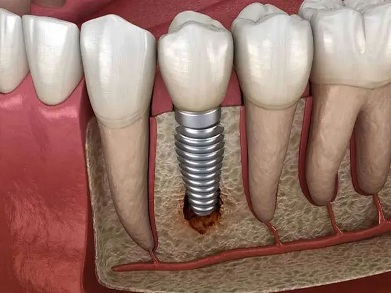 روند بهبودی پس از کاشت دندان