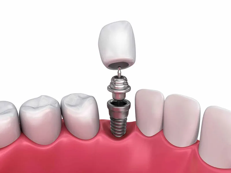 ایمپلنت دندان با بیهوشی